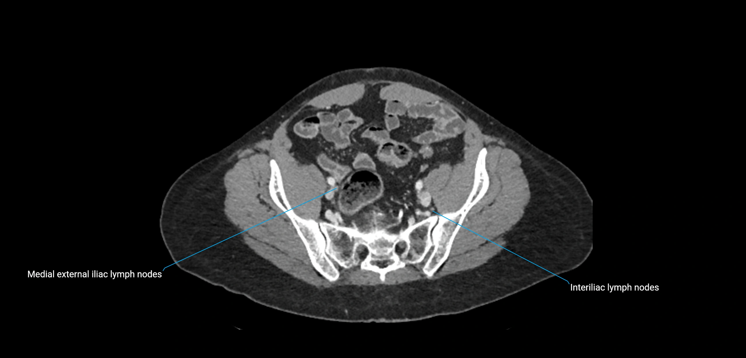 CT ct abdominal lymph nodes  axial cross sectional anatomy  enchanced radiology image -img-00002-00333.webp